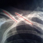 Schlüsselbein090802_2