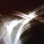 Schlüsselbein091130_2